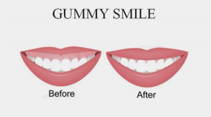 Десневая улыбка (gummy smile)
