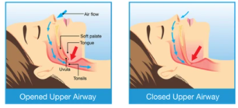 What is Anti-Snore Mouthguard?